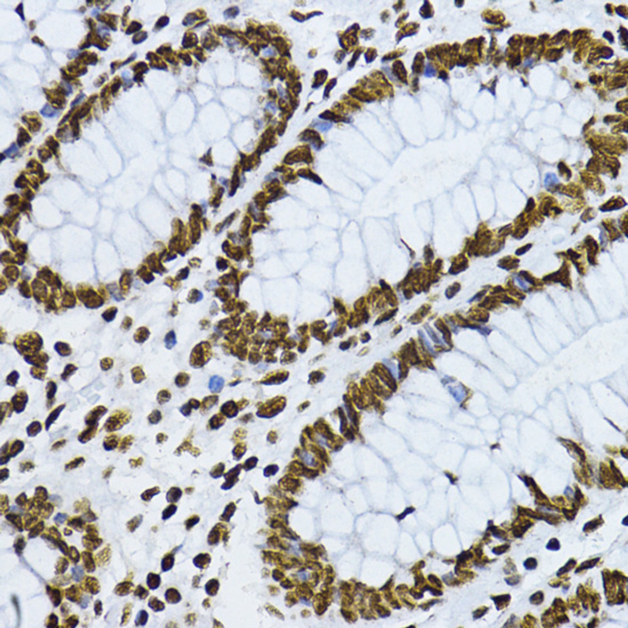 Immunohistochemistry of paraffin-embedded Human colon using Phospho-SMAD3(T179) Polyclonal Antibody at dilution of  1:200 (40x lens).