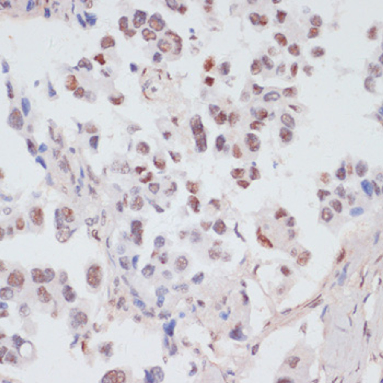 Immunohistochemistry of paraffin-embedded Human lung cancer using Phospho-PEA15(S104) Polyclonal Antibody at dilution of  1:100 (40x lens).