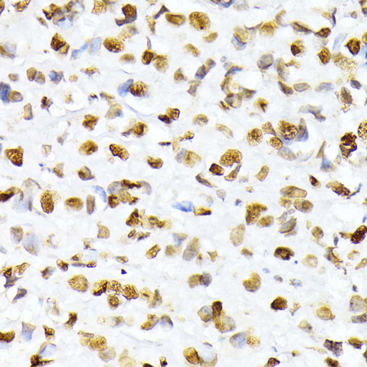 Immunohistochemistry of paraffin-embedded Human breast cancer using Phospho-Histone H2A(S129) Polyclonal Antibody at dilution of  1:100 (40x lens).