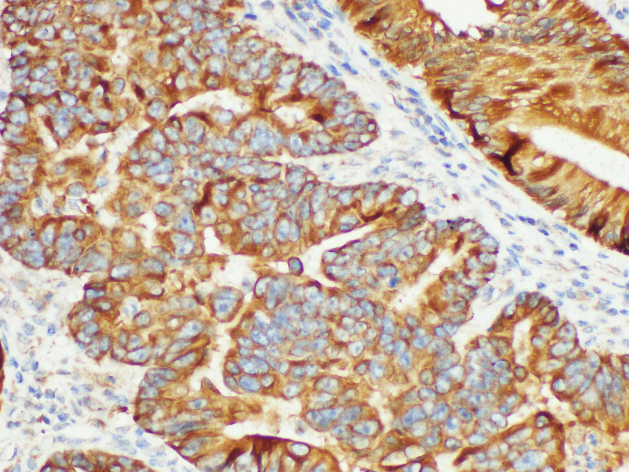 Immunohistochemistry of paraffin-embedded Human colon cancer using CK19 Polycloanl Antibody at dilution of 1:200.