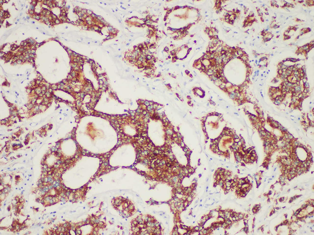 Immunohistochemistry of paraffinembedded Human prostate cancer tissue with AMACR/p504s Monoclonal Antibody(Antigen repaired by EDTA).