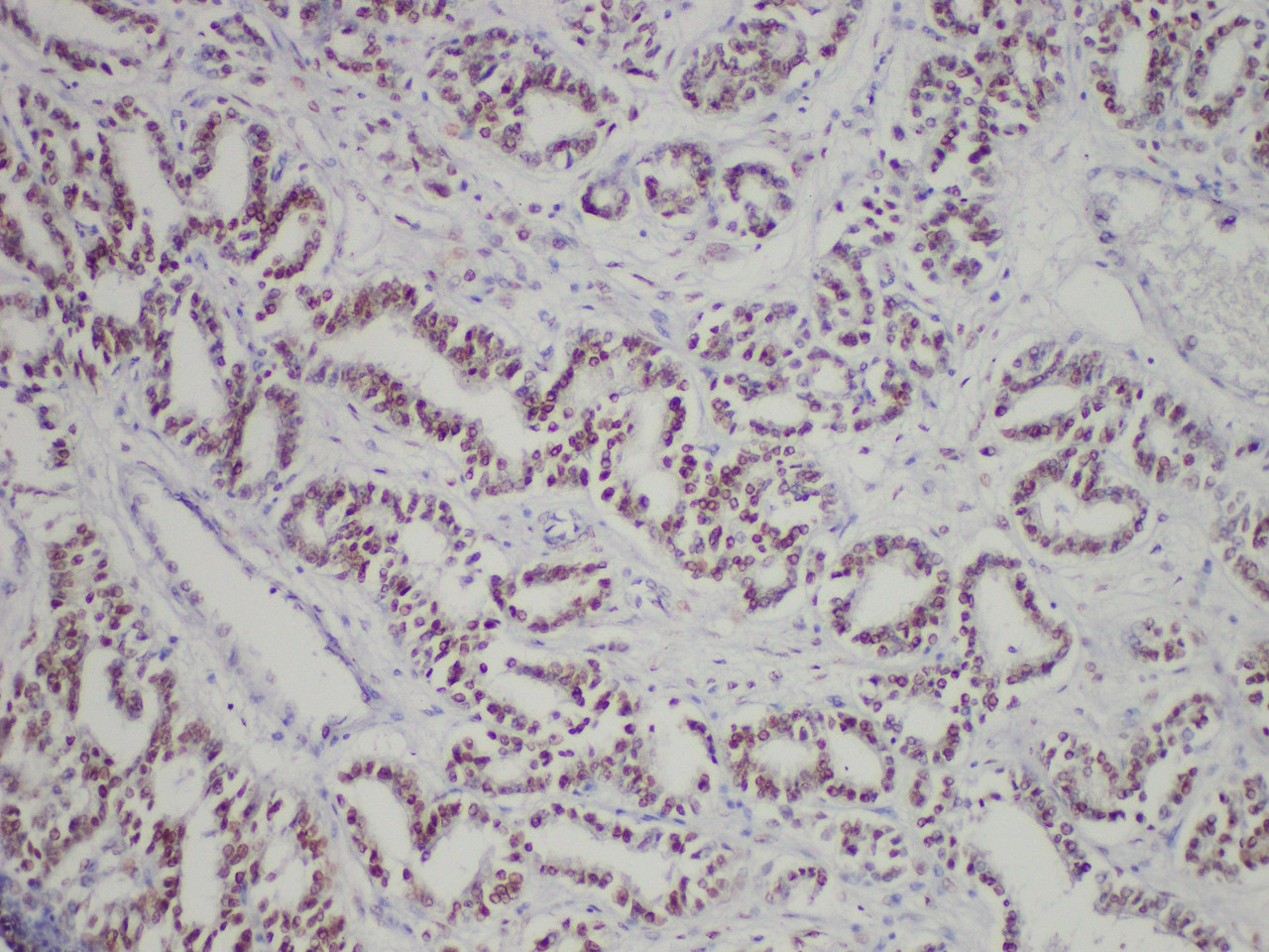 Immunohistochemistry of paraffinembedded Human prostate cancer tissue with Androgen Receptor(AR) Monoclonal Antibody(Antigen repaired by EDTA).