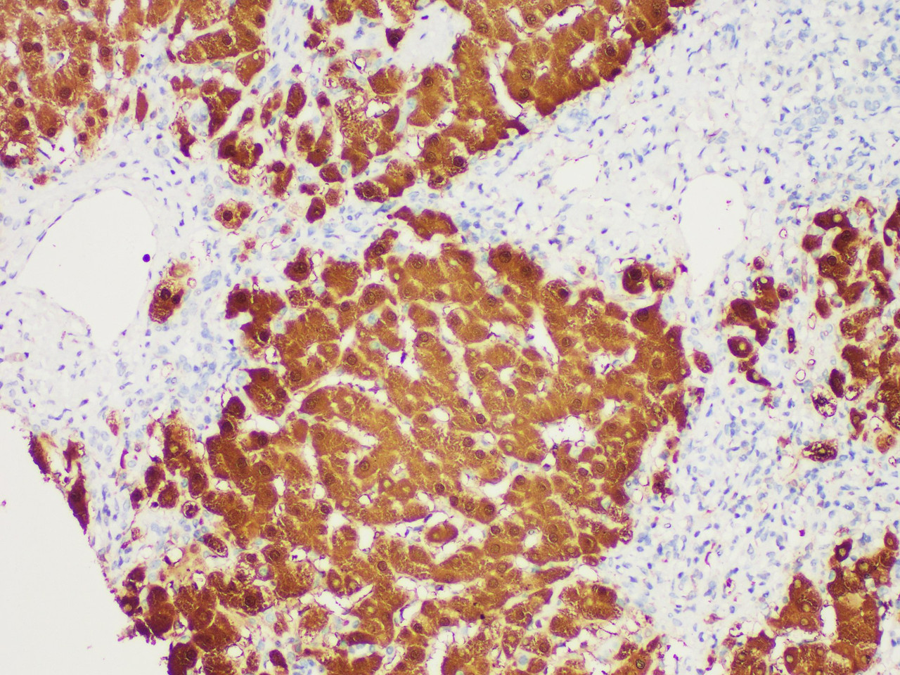 Immunohistochemistry of paraffinembedded Human liver cancer tissue with Arginase-1 Monoclonal Antibody(Antigen repaired by EDTA).