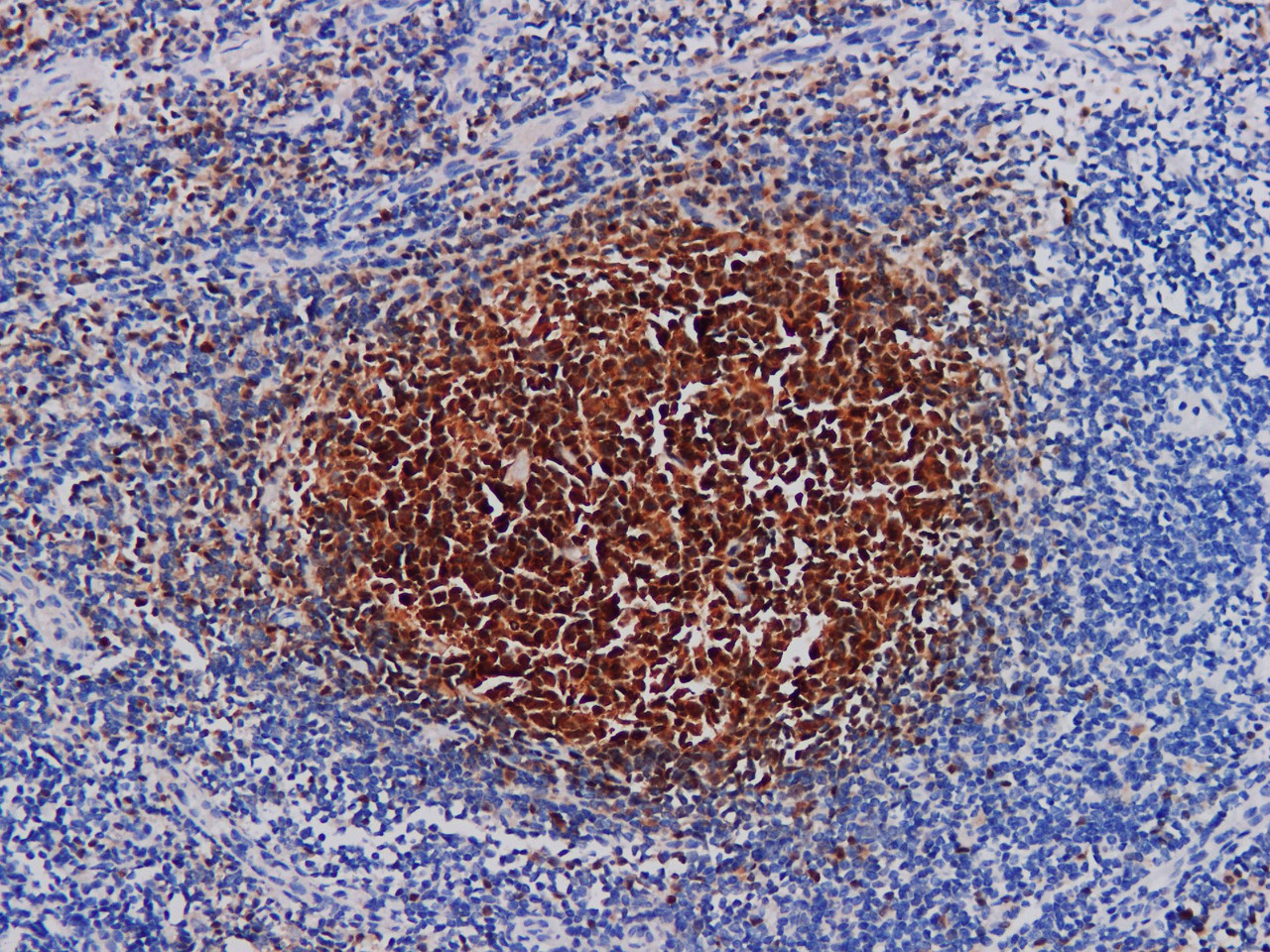 Immunohistochemistry of paraffinembedded Human tonsil tissue with BOB.1 Monoclonal Antibody(Antigen repaired by EDTA).