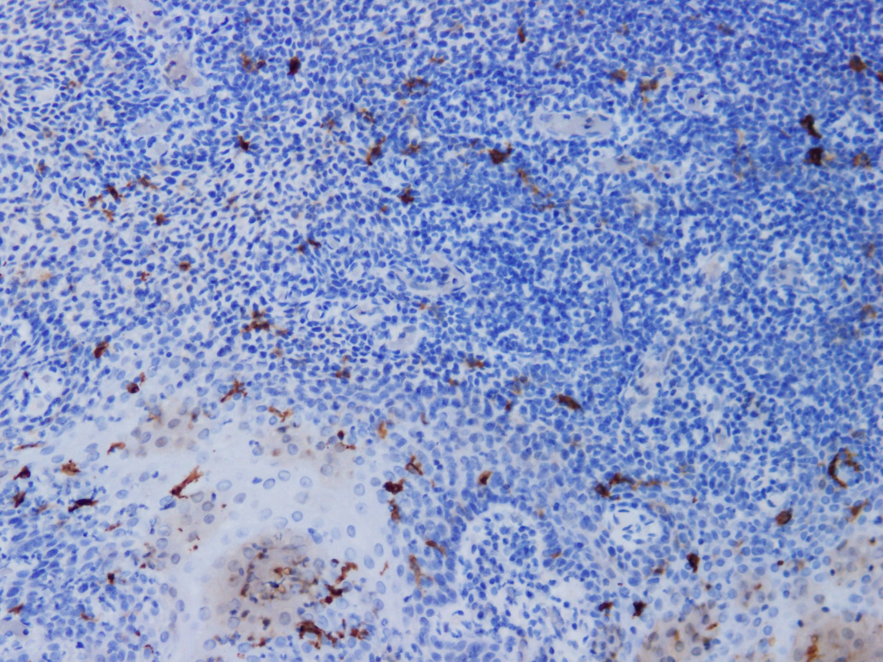 Immunohistochemistry of paraffinembedded Human tonsil tissue with CD1a Monoclonal Antibody(Antigen repaired by EDTA).