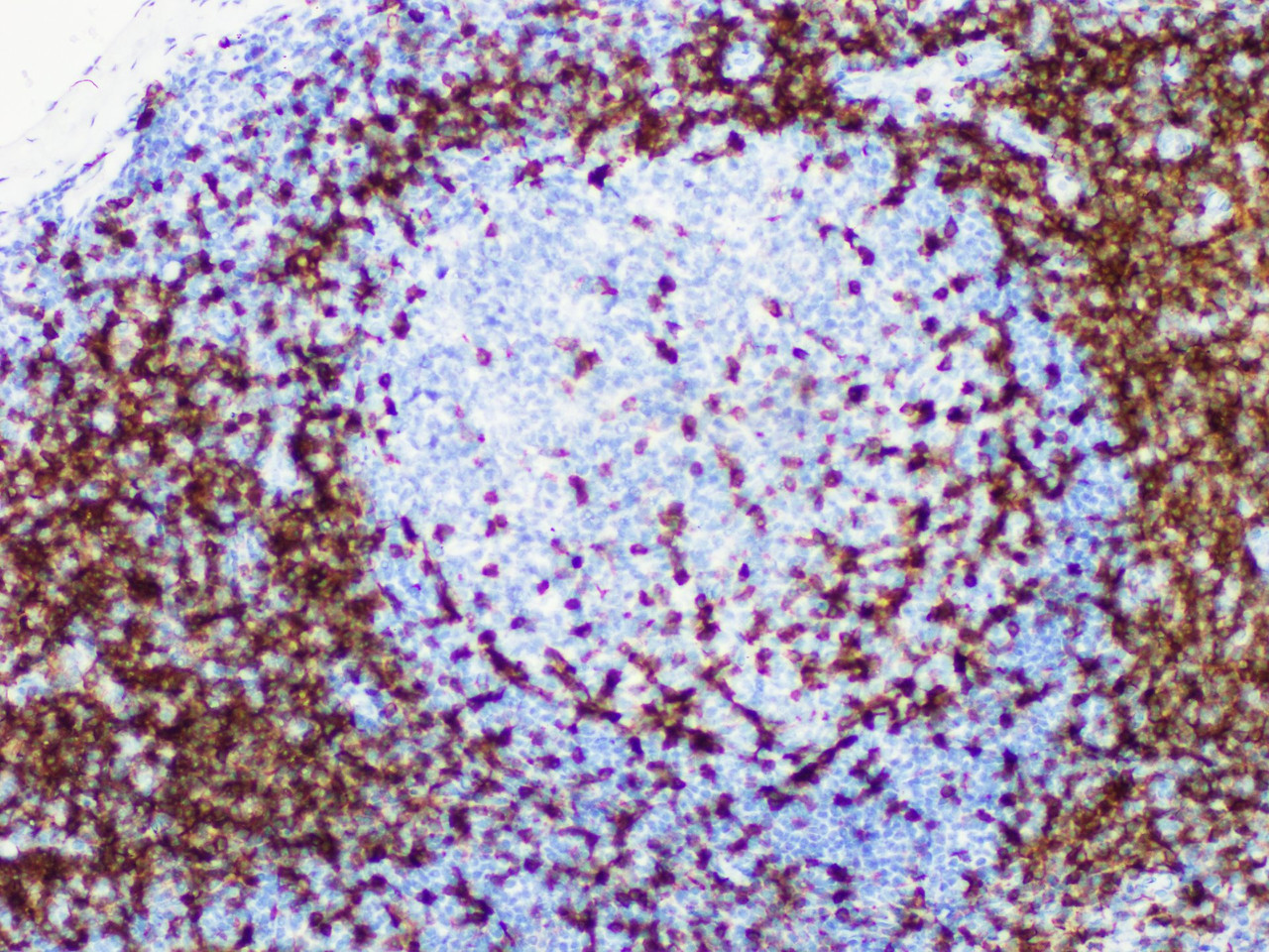 Immunohistochemistry of paraffinembedded Human tonsil tissue with CD5 Monoclonal Antibody(Antigen repaired by EDTA).