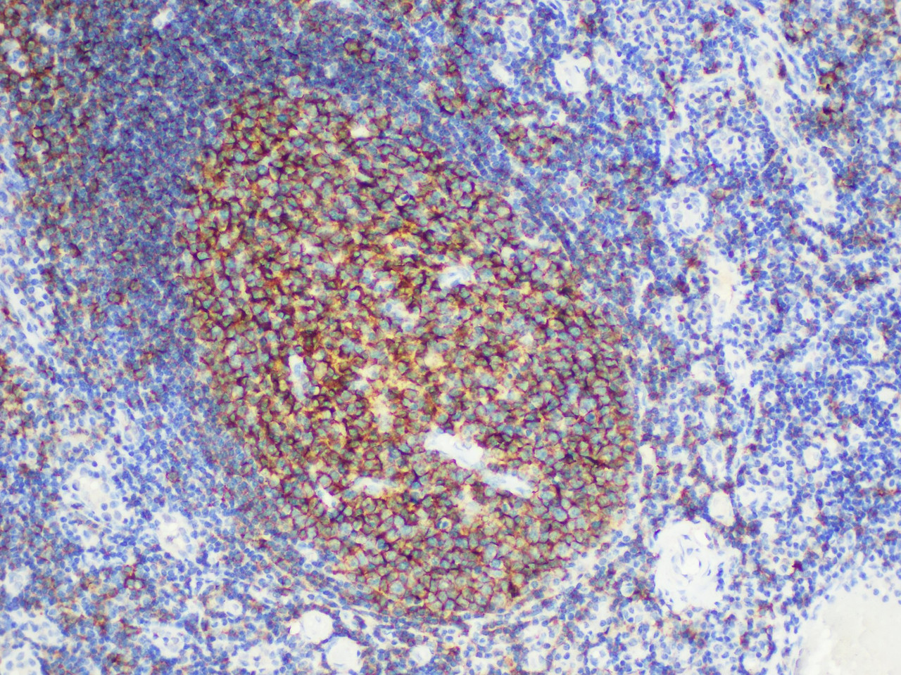 Immunohistochemistry of paraffinembedded Human tonsil tissue with CD20 Monoclonal Antibody(Antigen repaired by EDTA).