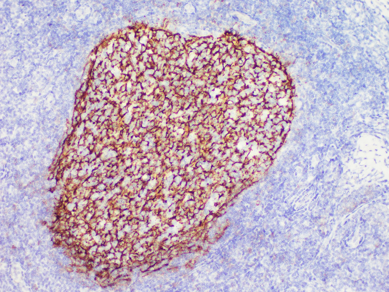 Immunohistochemistry of paraffinembedded Human tonsil tissue with CD21 Monoclonal Antibody(Antigen repaired by EDTA).