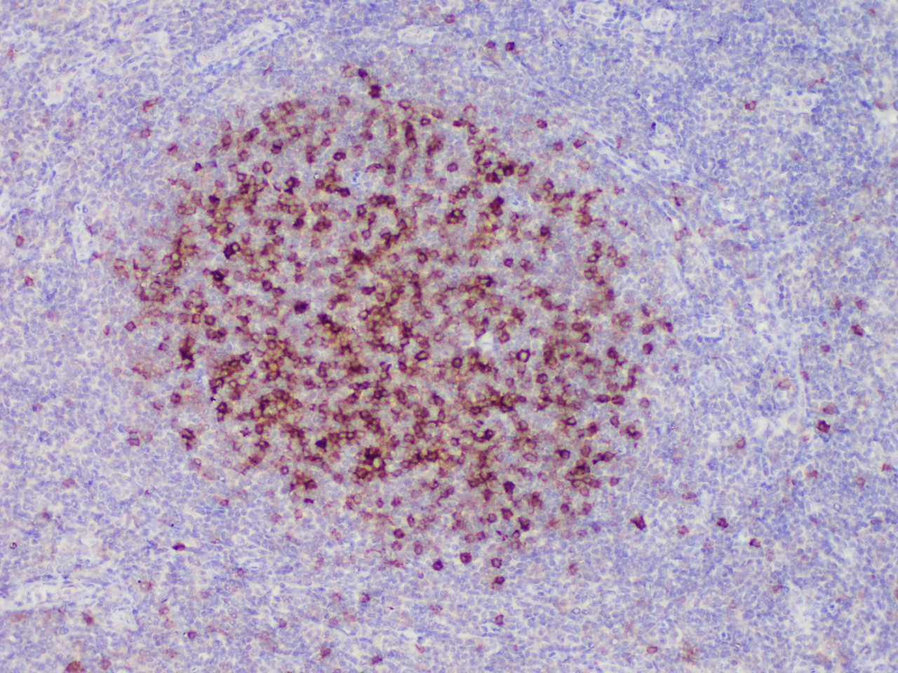 Immunohistochemistry of paraffinembedded Human tonsil tissue with CD23 Monoclonal Antibody(Antigen repaired by EDTA).