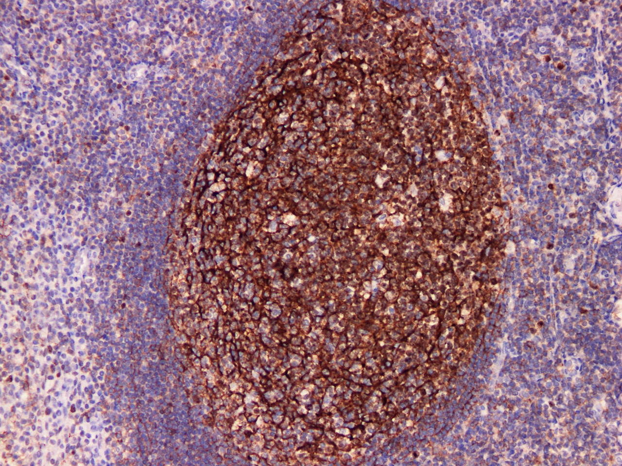 Immunohistochemistry of paraffinembedded Human tonsil tissue with CD35 Monoclonal Antibody(Antigen repaired by EDTA).