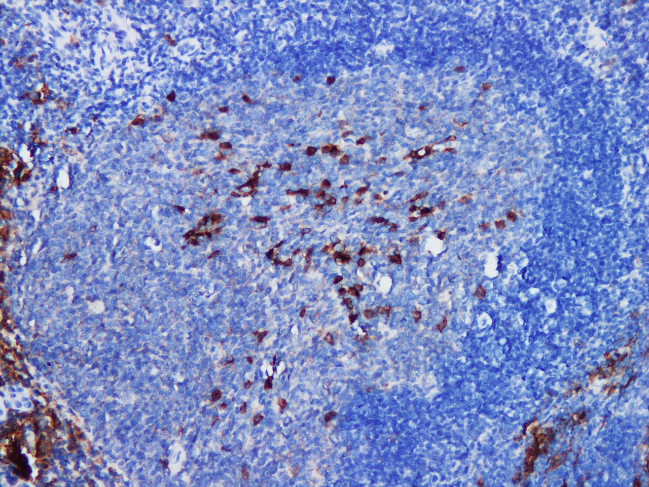 Immunohistochemistry of paraffinembedded Human tonsil tissue with CD38 Monoclonal Antibody(Antigen repaired by EDTA).