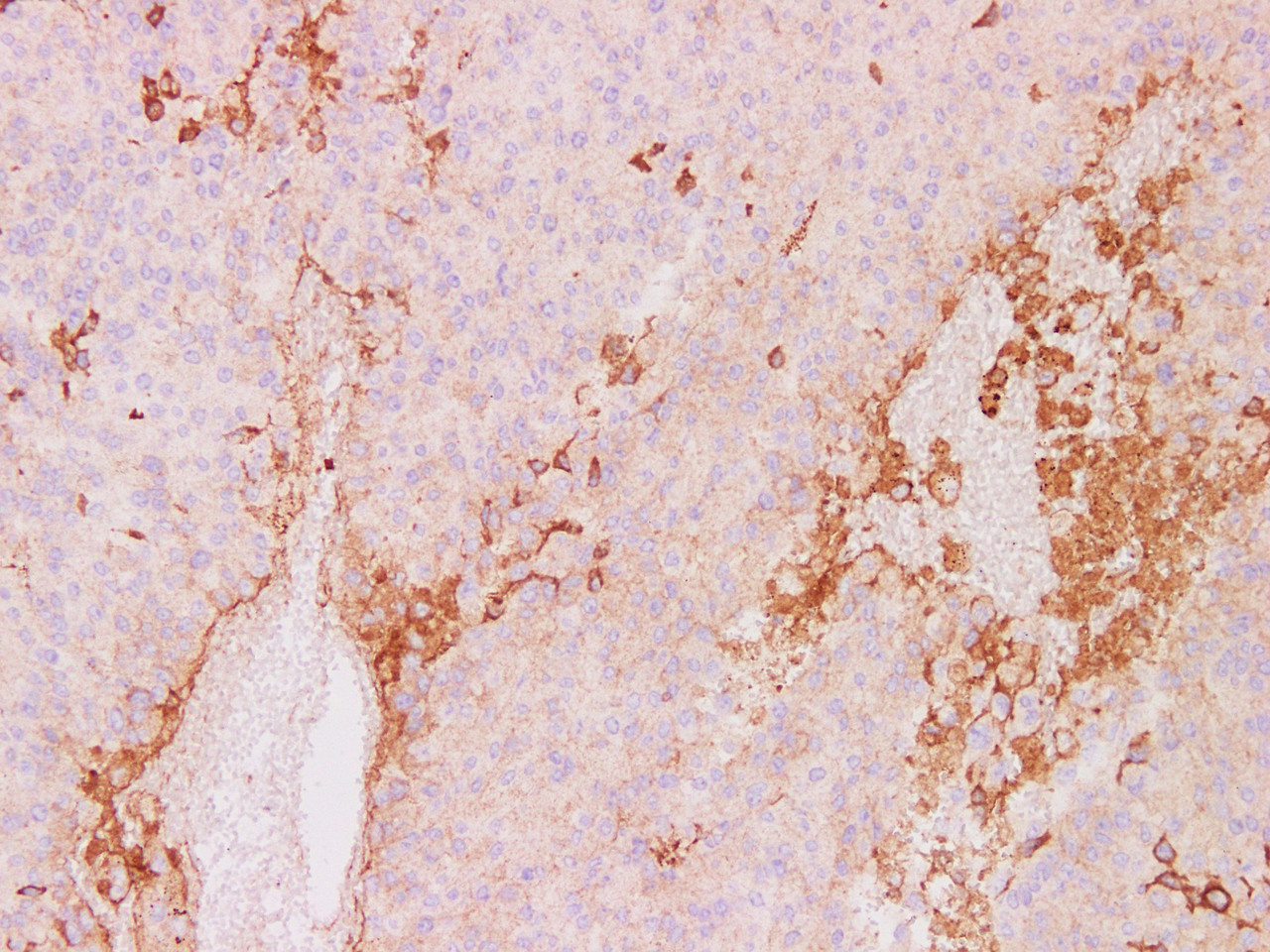Immunohistochemistry of paraffinembedded Human melanoma tissue with CD63 Monoclonal Antibody(Antigen repaired by EDTA).