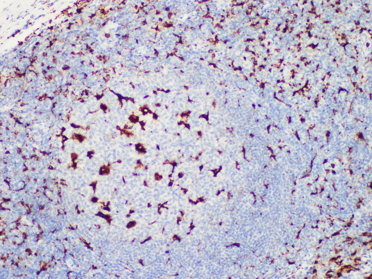 Immunohistochemistry of paraffinembedded Human tonsil tissue with CD68 Monoclonal Antibody(Antigen repaired by EDTA).