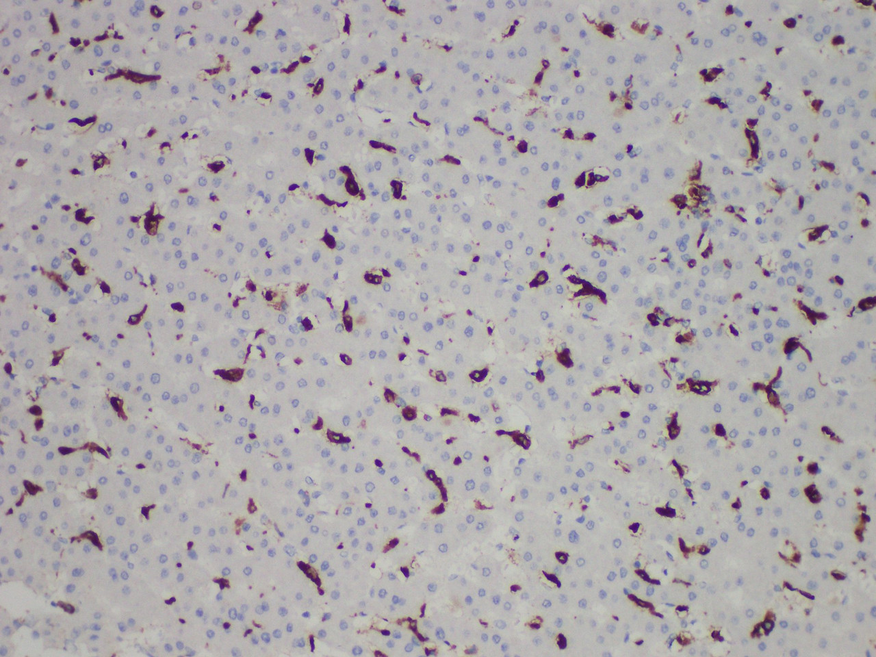 Immunohistochemistry of paraffinembedded Human liver tissue with CD163 Monoclonal Antibody(Antigen repaired by EDTA).