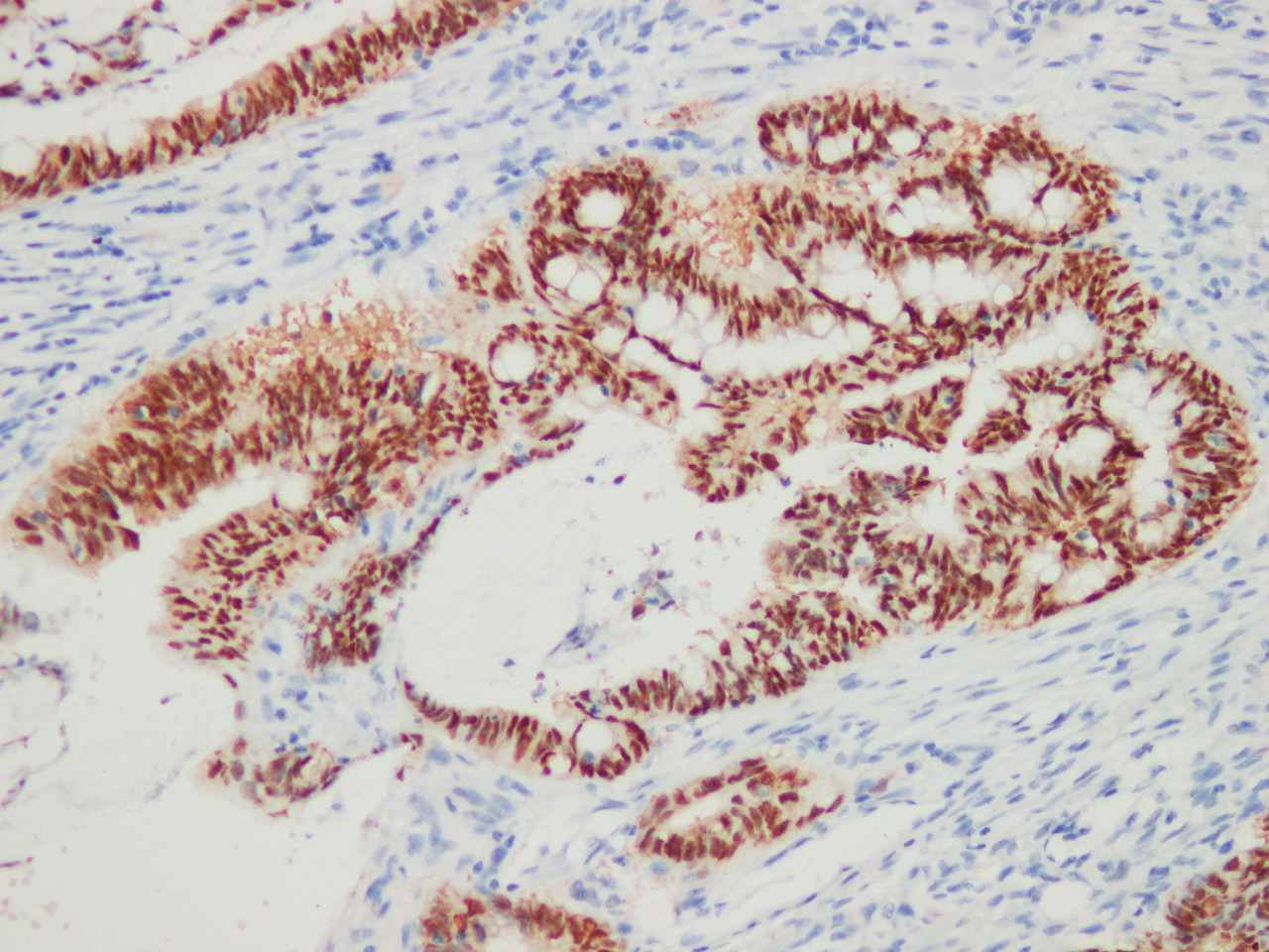 Immunohistochemistry of paraffinembedded Human colon cancer tissue with CDX-2 Monoclonal Antibody(Antigen repaired by EDTA).