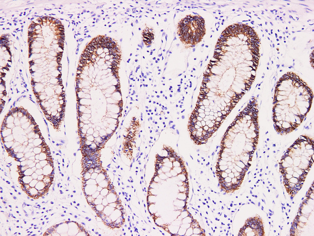 Immunohistochemistry of paraffinembedded Human colon tissue with Claudin 3 Monoclonal Antibody(Antigen repaired by EDTA).