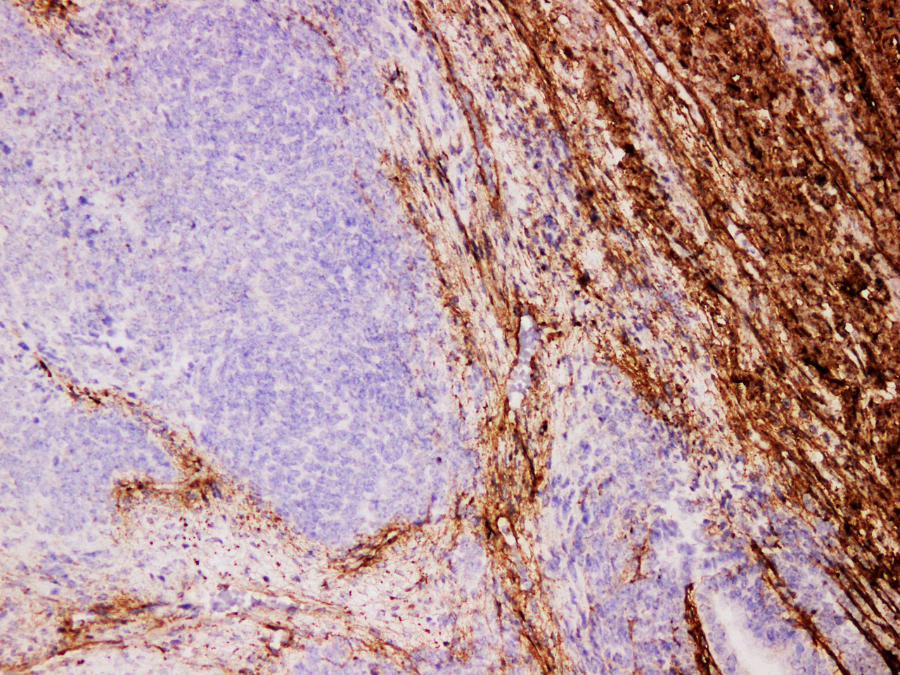 Immunohistochemistry of paraffinembedded Human kidney cancer tissue with Collagen Type Ⅲ Monoclonal Antibody(Antigen repaired by EDTA).
