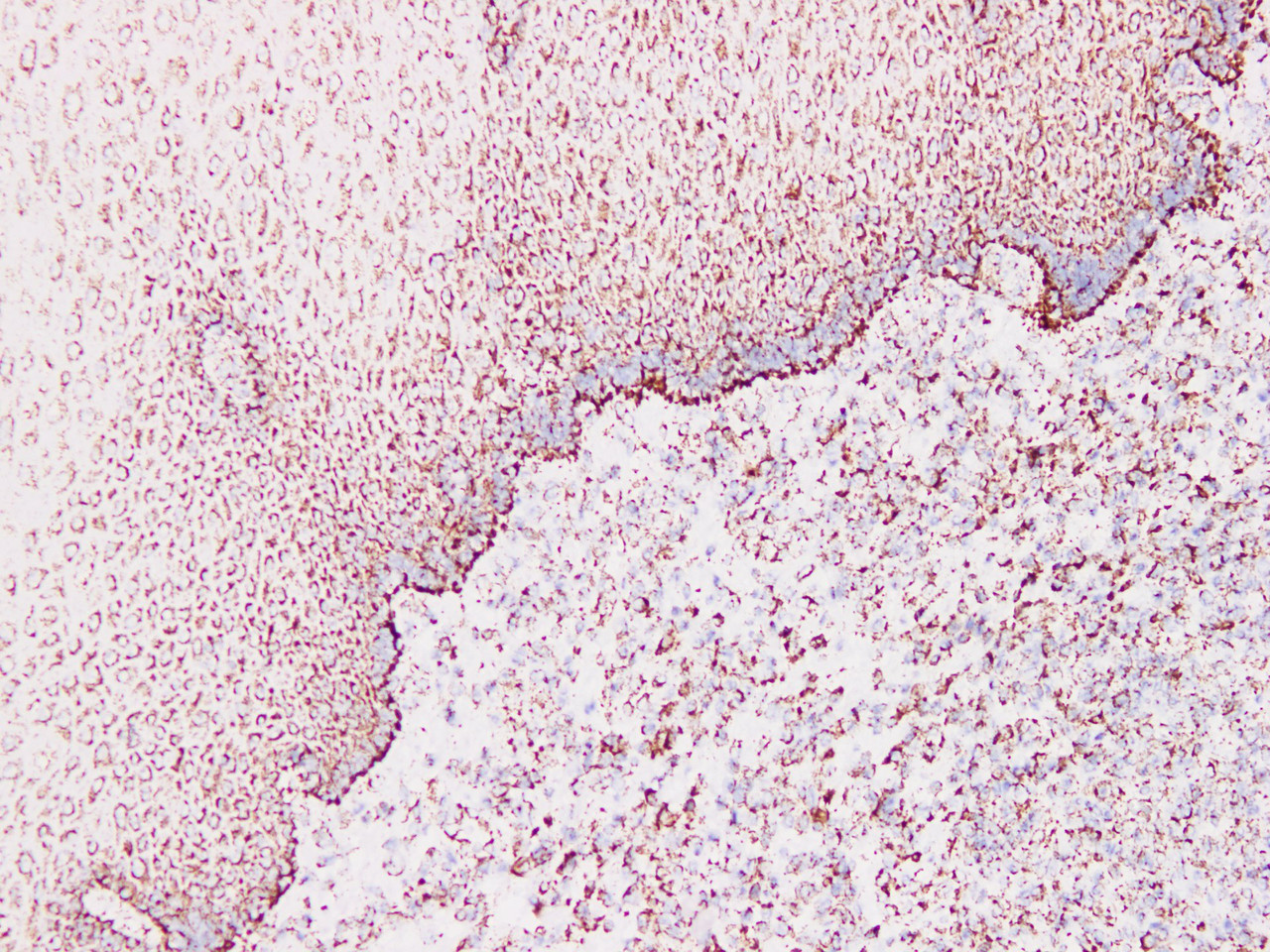 Immunohistochemistry of paraffinembedded Human esophageal cancer tissue with Cytokeratin 1 Monoclonal Antibody(Antigen repaired by EDTA).