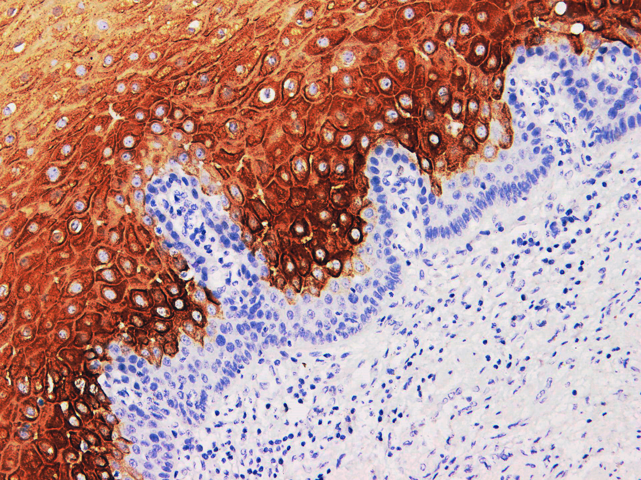 Immunohistochemistry of paraffinembedded Human esophageal cancer tissue with Cytokeratin 4 Monoclonal Antibody(Antigen repaired by EDTA).