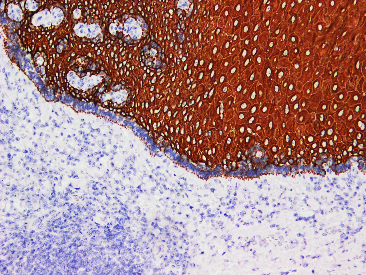 Immunohistochemistry of paraffinembedded Human esophageal cancer tissue with Cytokeratin 5/6 Monoclonal Antibody(Antigen repaired by EDTA).