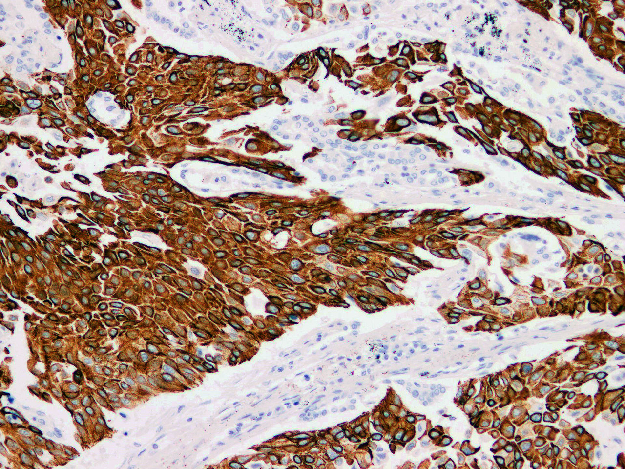 Immunohistochemistry of paraffinembedded Human lung squamous cell carcinoma with Cytokeratin 13 Monoclonal Antibody(Antigen repaired by EDTA).