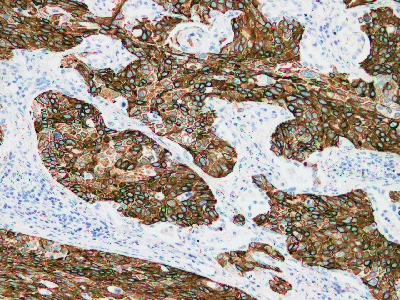 Immunohistochemistry of paraffinembedded Human lung squamous cell carcinoma with Cytokeratin 15 Monoclonal Antibody(Antigen repaired by EDTA).