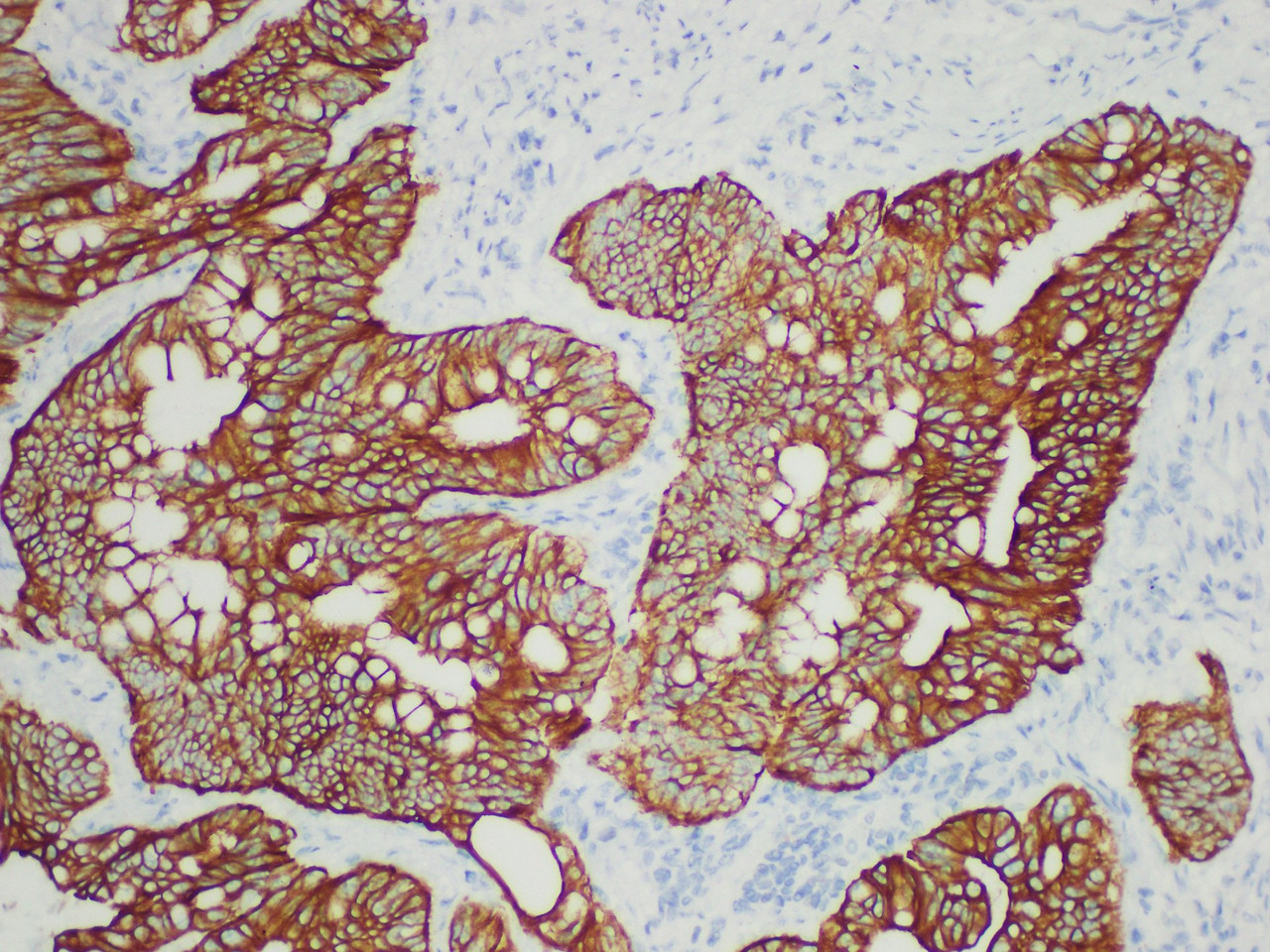 Immunohistochemistry of paraffinembedded Human colon cancer tissue with Cytokeratin 19 Monoclonal Antibody(Antigen repaired by EDTA).