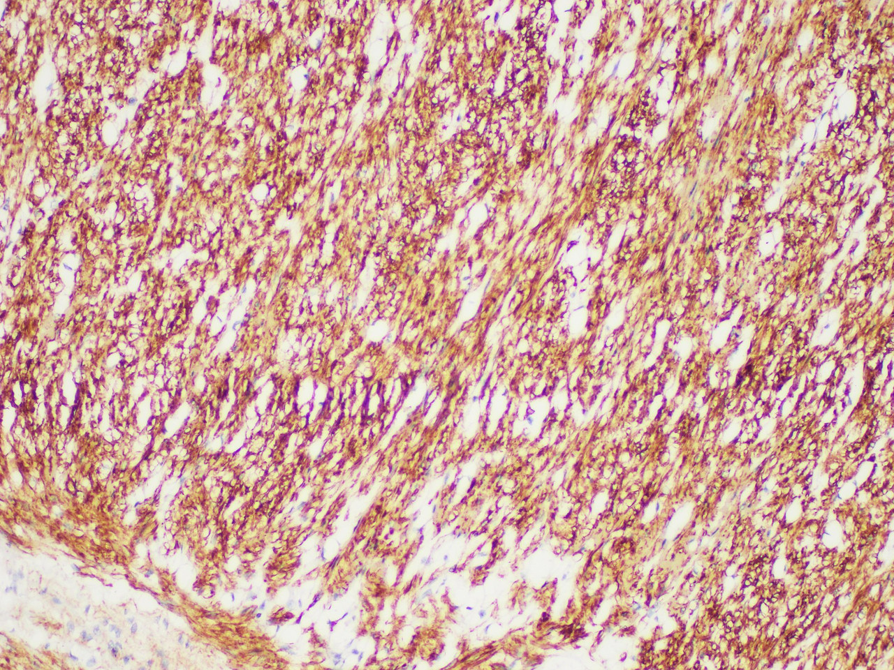 Immunohistochemistry of paraffinembedded Human colonic smooth muscle with Desmin Monoclonal Antibody(Antigen repaired by EDTA).