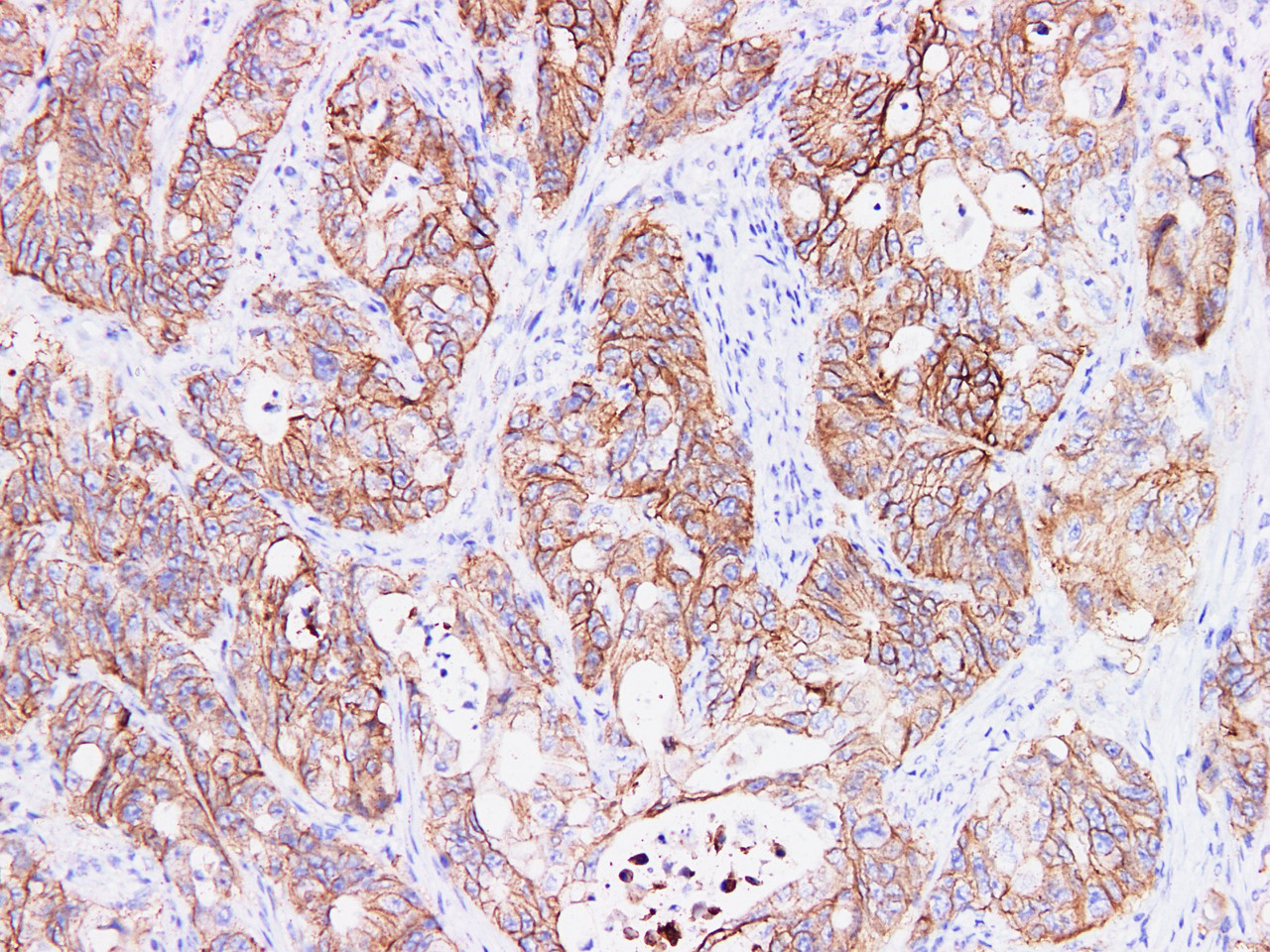 Immunohistochemistry of paraffinembedded Human colon cancer tissue with Ep-CAM Monoclonal Antibody(Antigen repaired by EDTA).