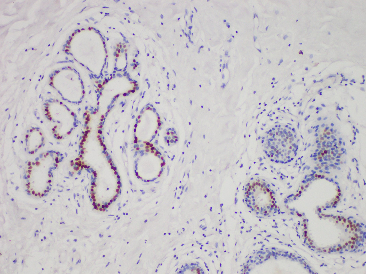 Immunohistochemistry of paraffinembedded Human breast cancer tissue with Estrogen Receptor α(ER) Monoclonal Antibody(Antigen repaired by EDTA).