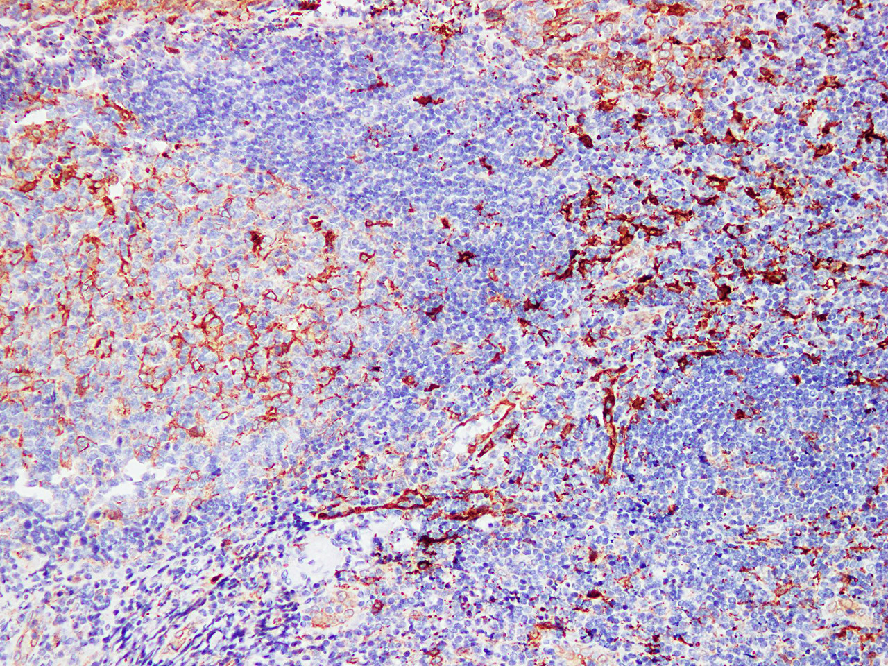Immunohistochemistry of paraffinembedded Human tonsil tissue with Fascin Monoclonal Antibody(Antigen repaired by EDTA).