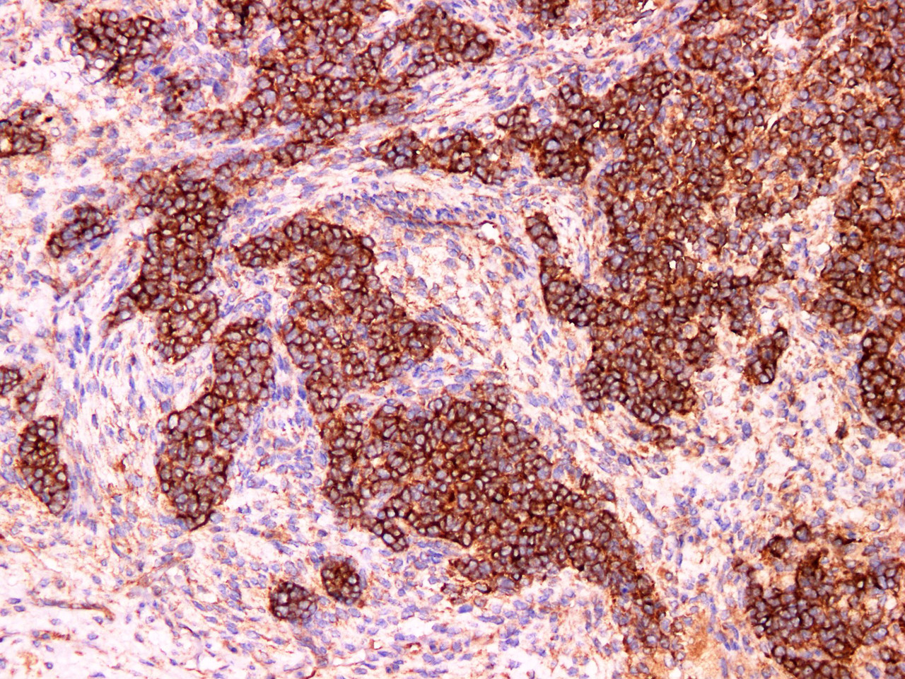 Immunohistochemistry of paraffinembedded Human kidney cancer tissue with HDAC6 Monoclonal Antibody(Antigen repaired by EDTA).