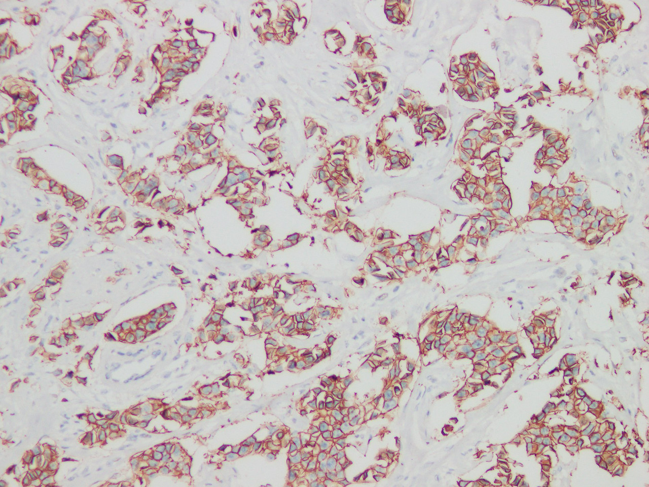 Immunohistochemistry of paraffinembedded Human breast cancer tissue with Her-2 Monoclonal Antibody(Antigen repaired by EDTA).