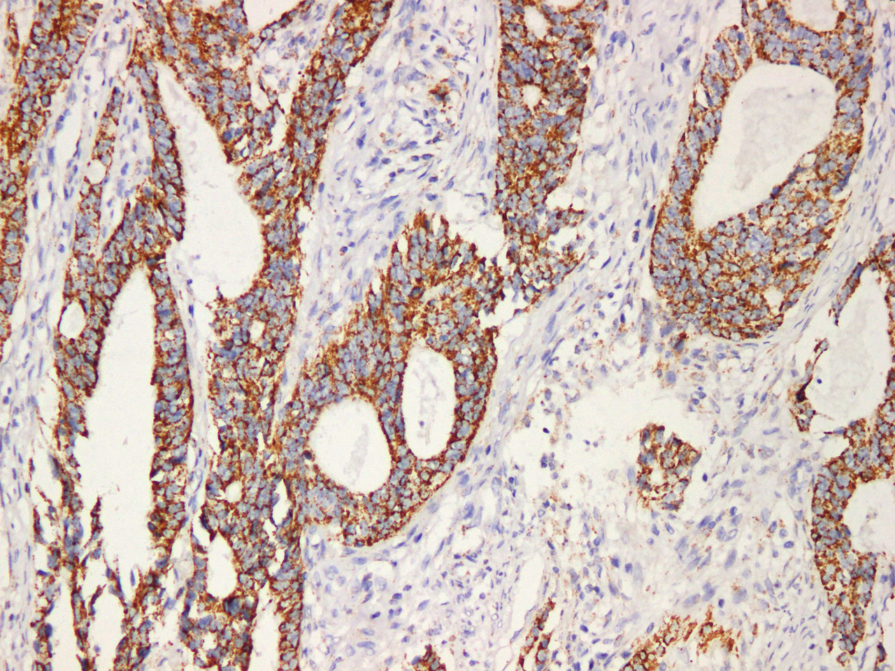 Immunohistochemistry of paraffinembedded Human colon cancer tissue with HSP60 Monoclonal Antibody(Antigen repaired by EDTA).