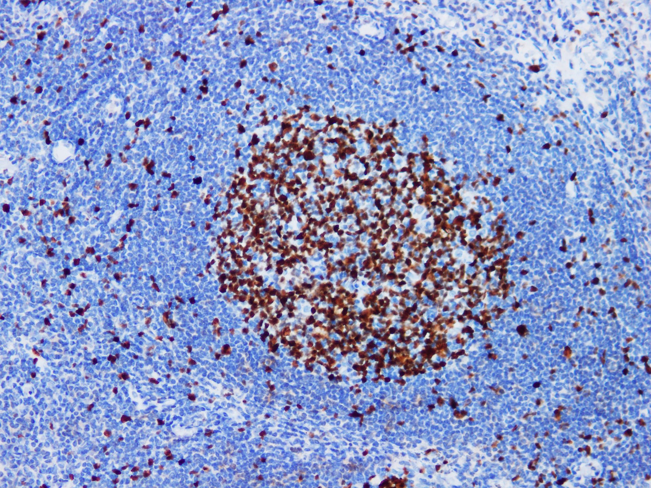 Immunohistochemistry of paraffinembedded Human tonsil tissue with Ki-67 Monoclonal Antibody(Antigen repaired by EDTA).