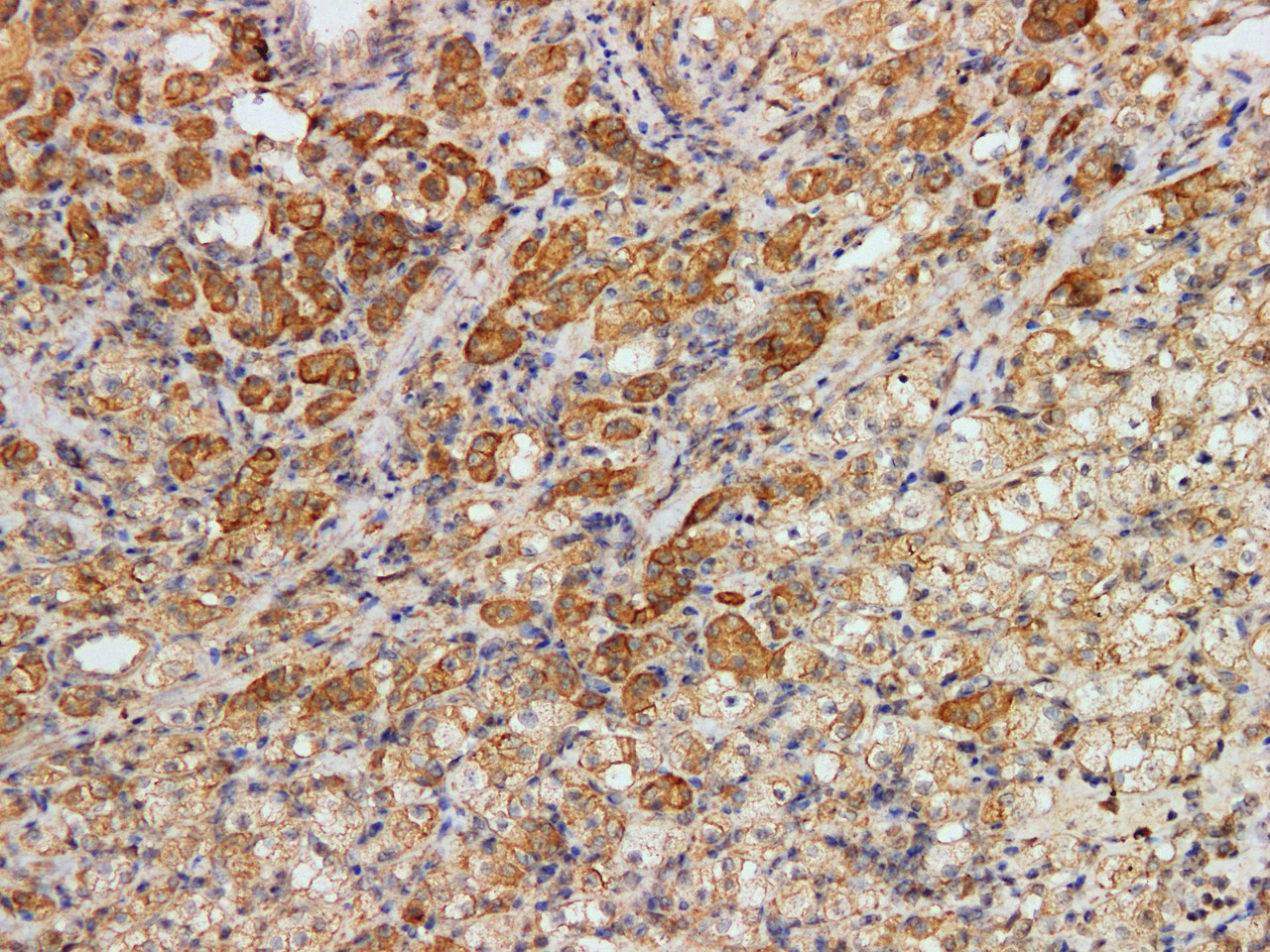 Immunohistochemistry of paraffinembedded Human renal clear cell carcinoma tissue with Kidney-specific cadherin(KSP-Cad) Monoclonal Antibody(Antigen repaired by EDTA).