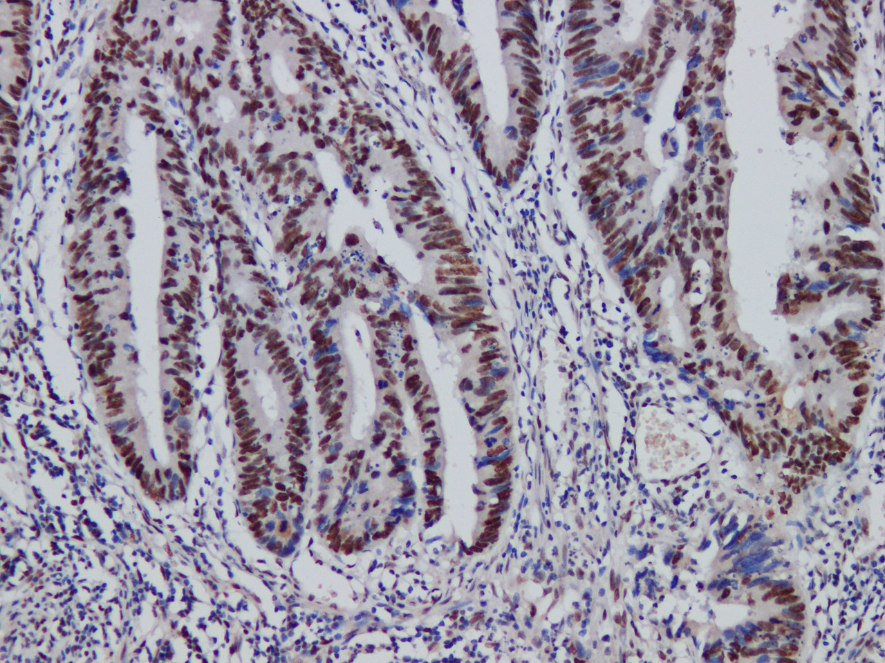 Immunohistochemistry of paraffinembedded Human colon cancer tissue with MutS Protein Homolog 2(MSH2) Monoclonal Antibody(Antigen repaired by EDTA).