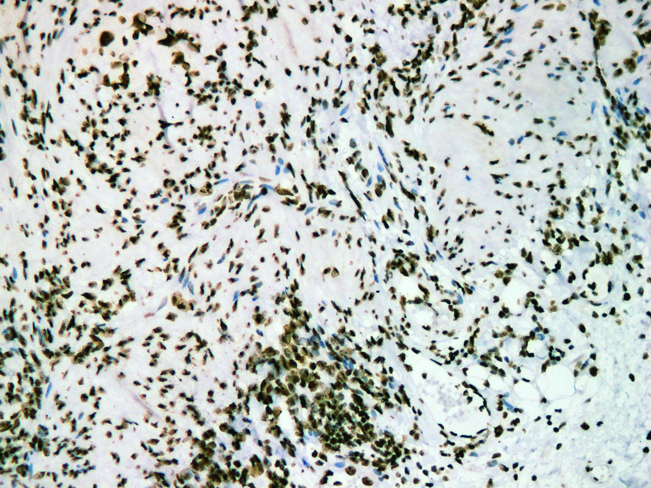 Immunohistochemistry of paraffinembedded Human colon cancer tissue with Nucleophosmin(NPM) Monoclonal Antibody(Antigen repaired by EDTA).