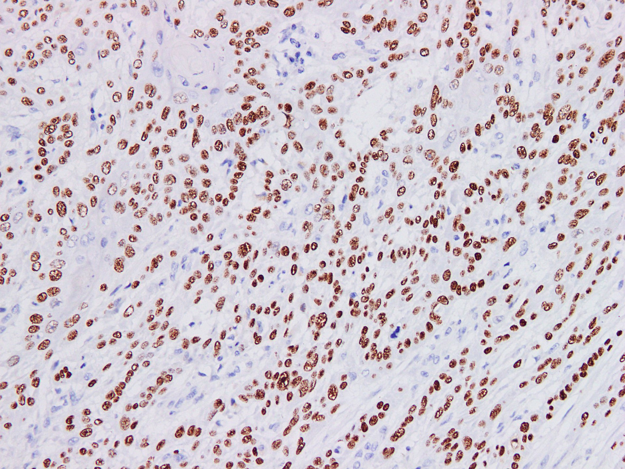 Immunohistochemistry of paraffinembedded Human esophageal cancer tissue with p40 Monoclonal Antibody(Antigen repaired by EDTA).