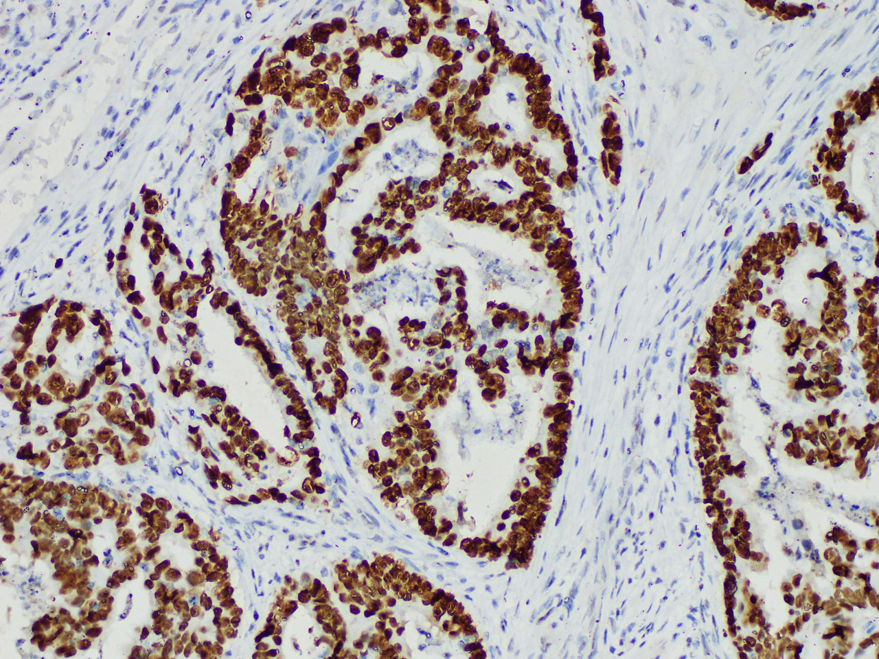 Immunohistochemistry of paraffinembedded Human colon cancer tissue with p53 Monoclonal Antibody(Antigen repaired by EDTA).