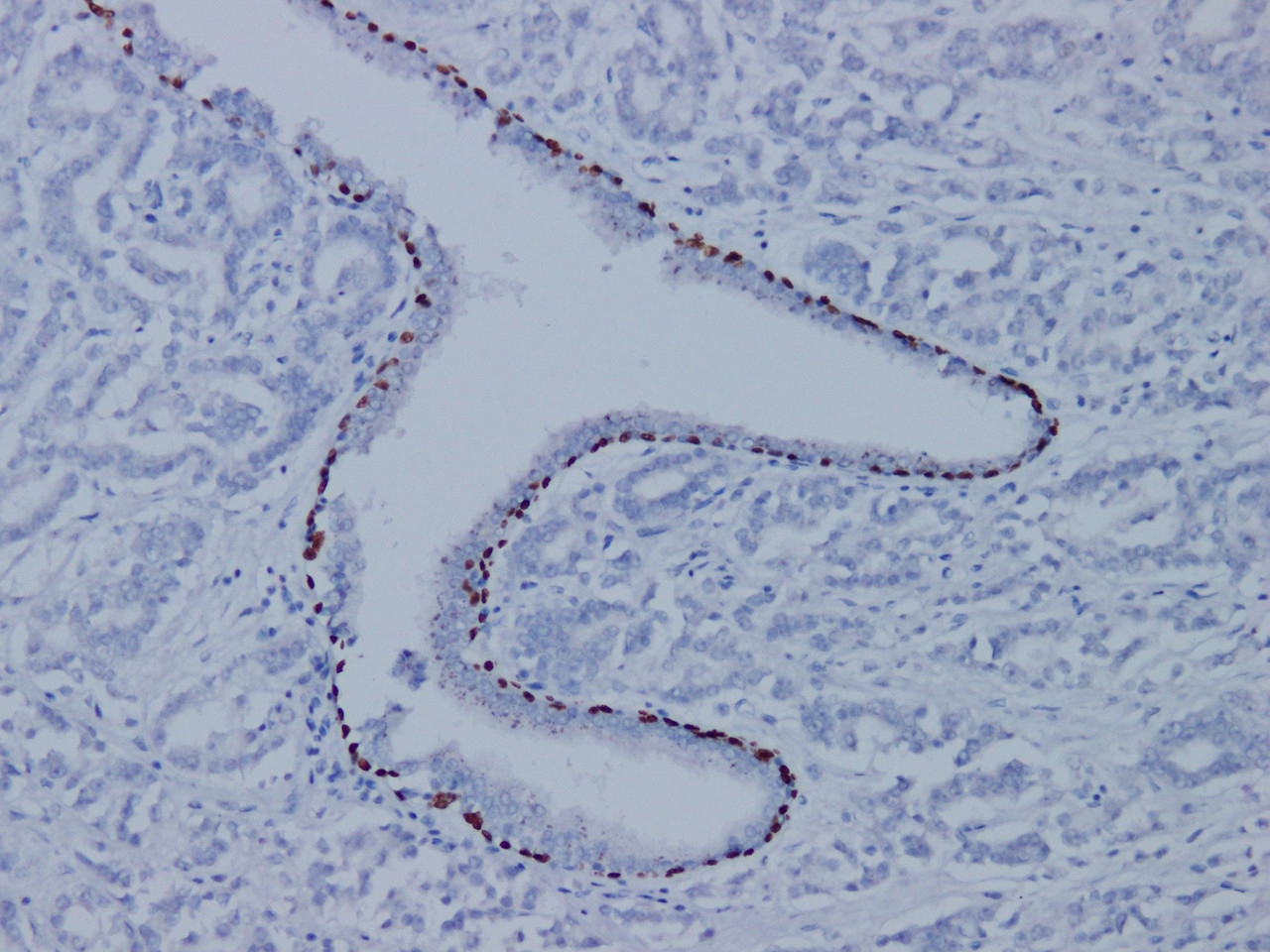 Immunohistochemistry of paraffinembedded Human prostate cancer tissue with p63 Monoclonal Antibody(Antigen repaired by EDTA).