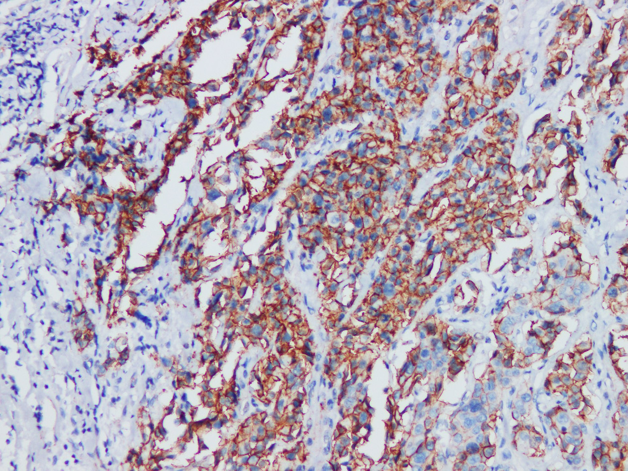 Immunohistochemistry of paraffinembedded Human breast cancer tissue with p120 Monoclonal Antibody(Antigen repaired by EDTA).