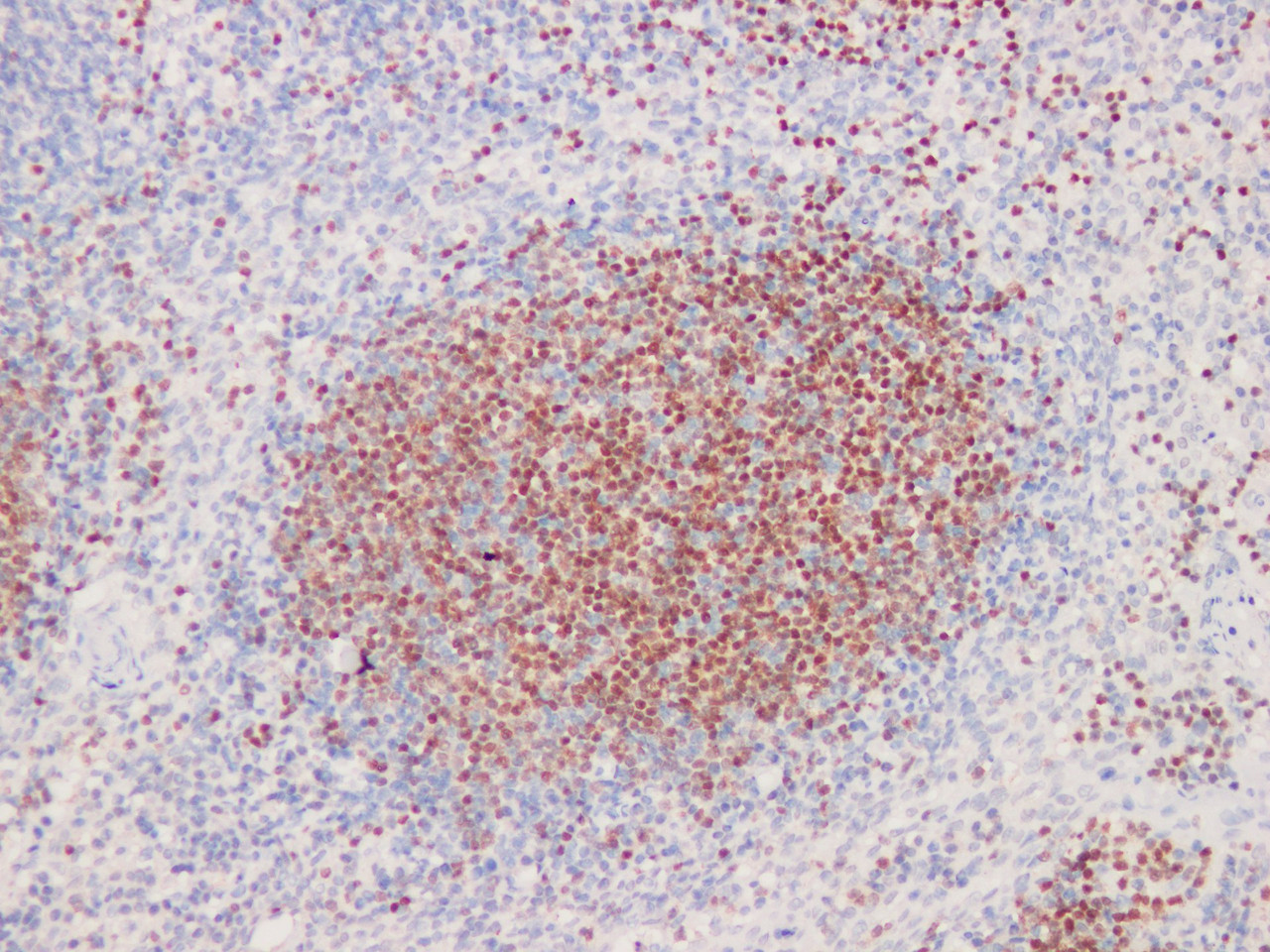 Immunohistochemistry of paraffinembedded Human tonsil tissue with Pax-5 Monoclonal Antibody(Antigen repaired by EDTA).