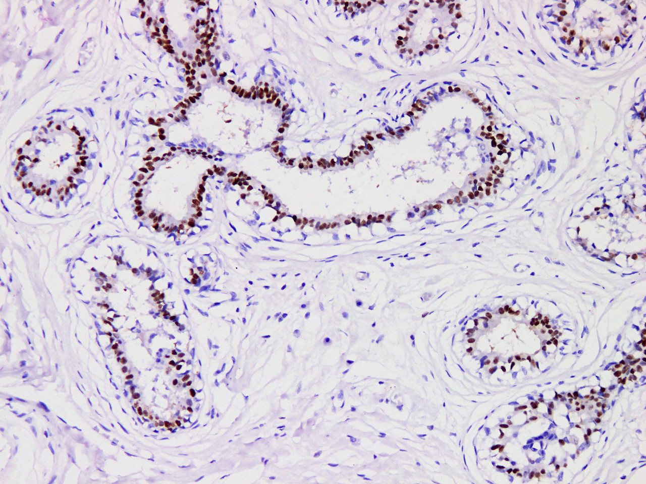 Immunohistochemistry of paraffinembedded Human breast cancer tissue with Progesterone Receptor(PR) Monoclonal Antibody(Antigen repaired by EDTA).
