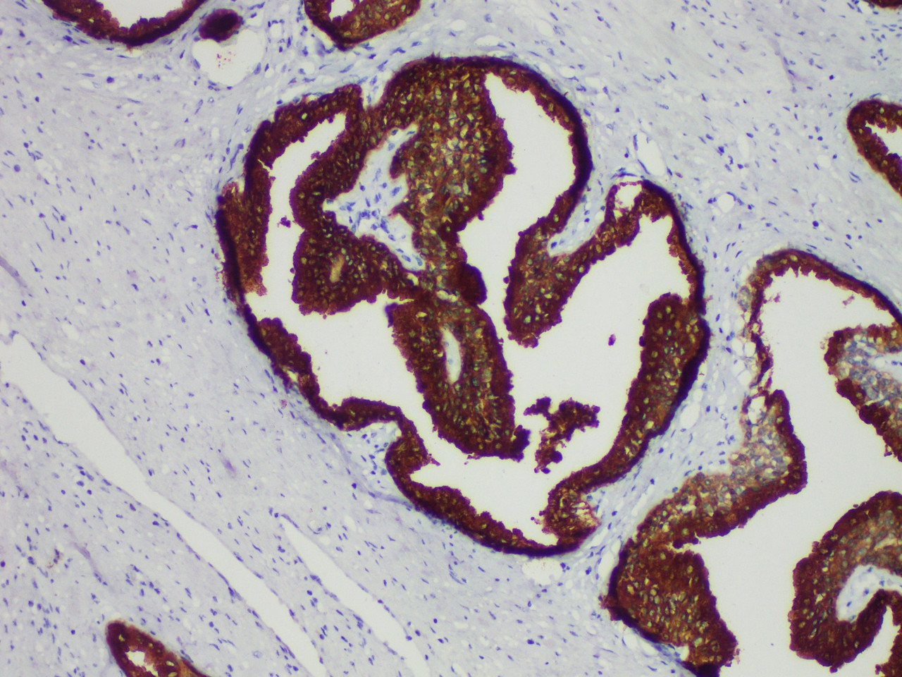 Immunohistochemistry of paraffinembedded Human prostate cancer tissue with Prostate-Specific Antigen(PSA) Monoclonal Antibody(Antigen repaired by EDTA).