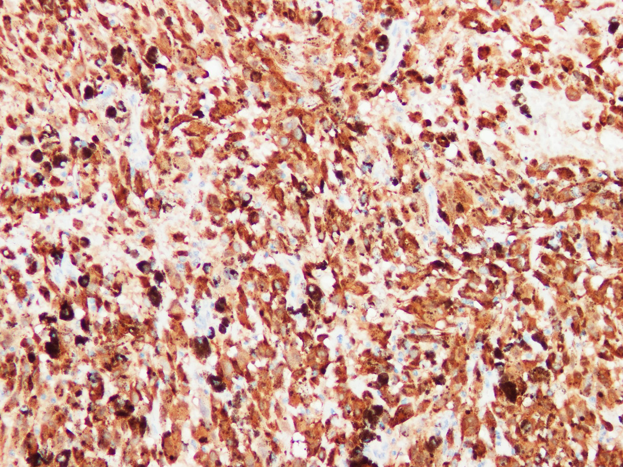 Immunohistochemistry of paraffinembedded Human melanoma tissue with S100 Monoclonal Antibody(Antigen repaired by EDTA).