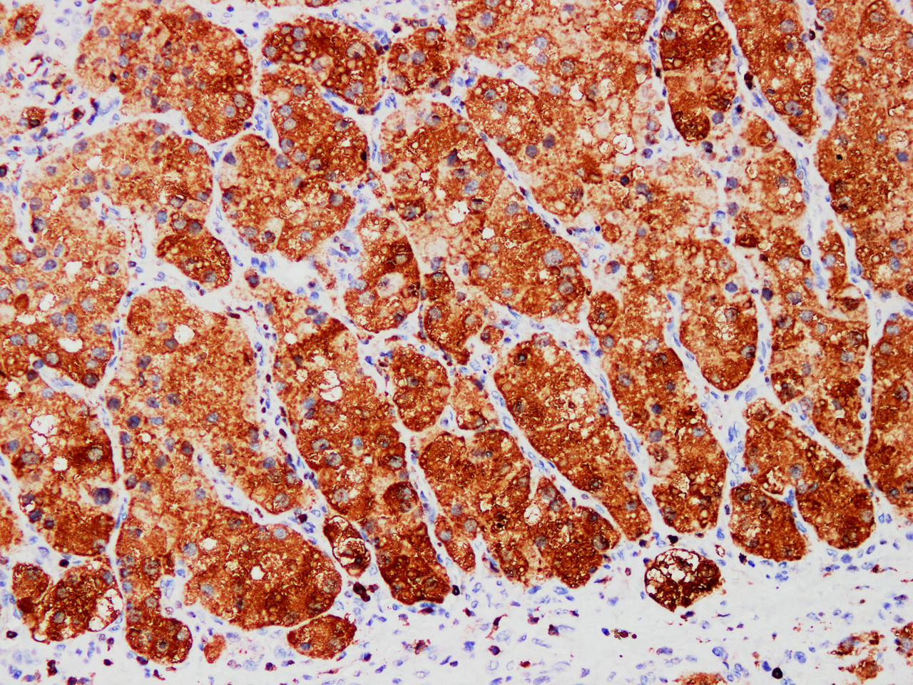 Immunohistochemistry of paraffinembedded Human kidney cancer tissue with S100A1 Monoclonal Antibody(Antigen repaired by EDTA).