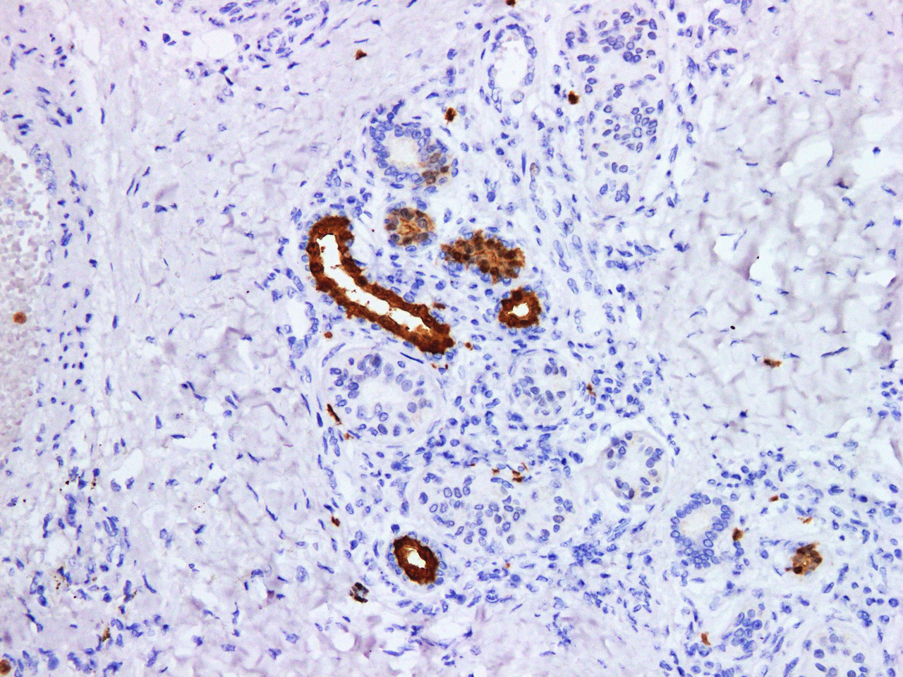 Immunohistochemistry of paraffinembedded Human melanoma tissue with S100P Monoclonal Antibody(Antigen repaired by EDTA).