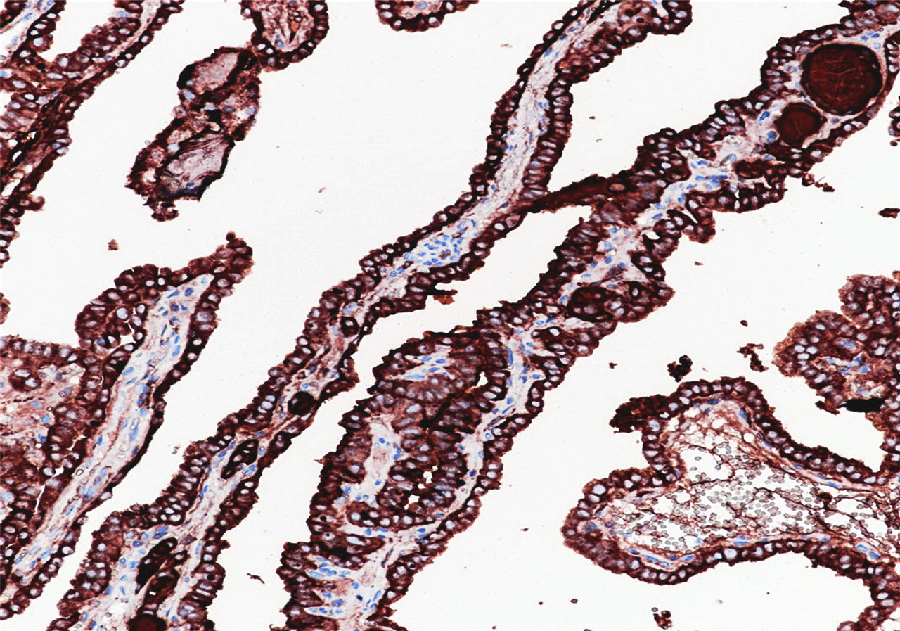 Immunohistochemistry of paraffinembedded Human thyroid tissue with Thyroglobulin(TG) Monoclonal Antibody(Antigen repaired by EDTA).