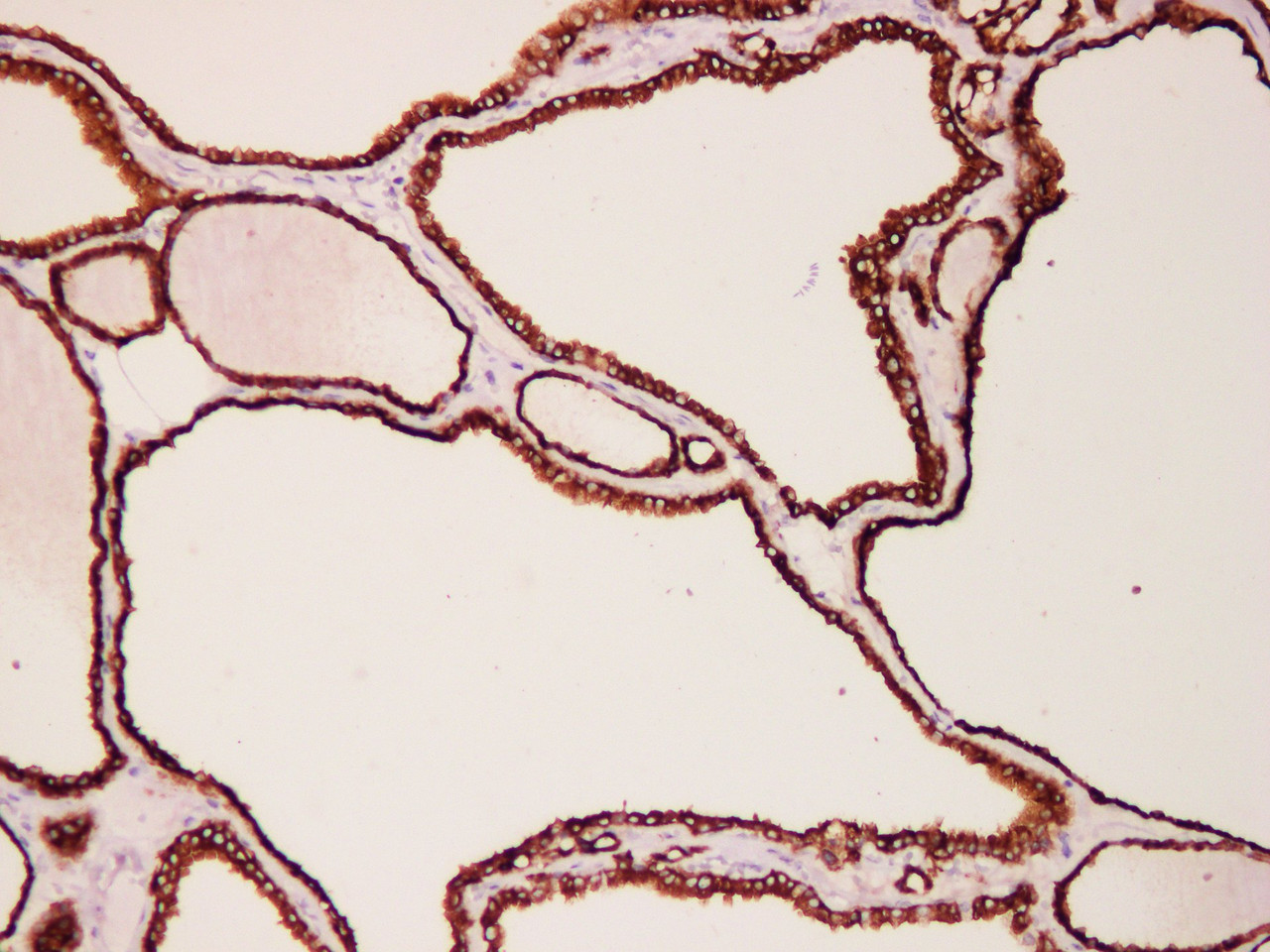 Immunohistochemistry of paraffinembedded Human thyroid tissue with Thyroid Peroxidase(TPO) Monoclonal Antibody(Antigen repaired by EDTA).